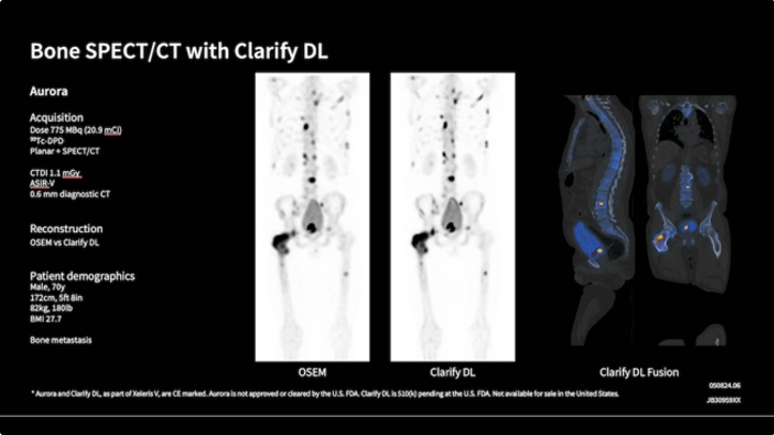 bone-spect-ct-clarify-dl-image-reconstruction-comparison